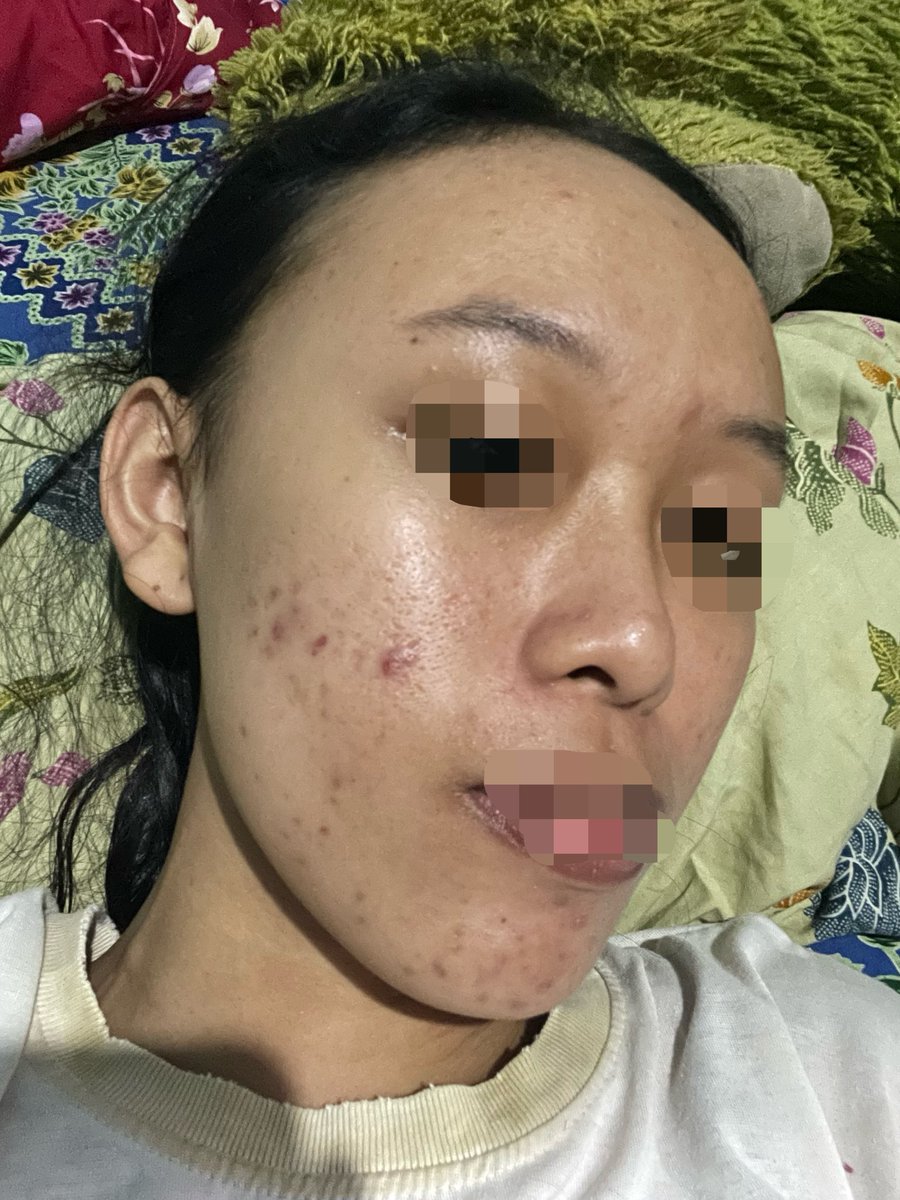 Holla_hop's tweet photo. Saran dong kakak2 ini harus pake produk apa?  Kulitku kering trs pori besar sama komedo. Pake fc you, moist you sama ss wardah ijo spf 50. https://t.co/hiEXXO3c6Q