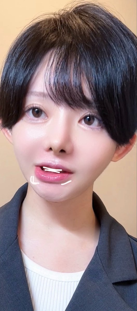 分かりますか?
骨切りDTで唇が歪むんです、、
顎の拘縮と運動神経麻痺かな😖 https://t.co/QD5iLXULYy