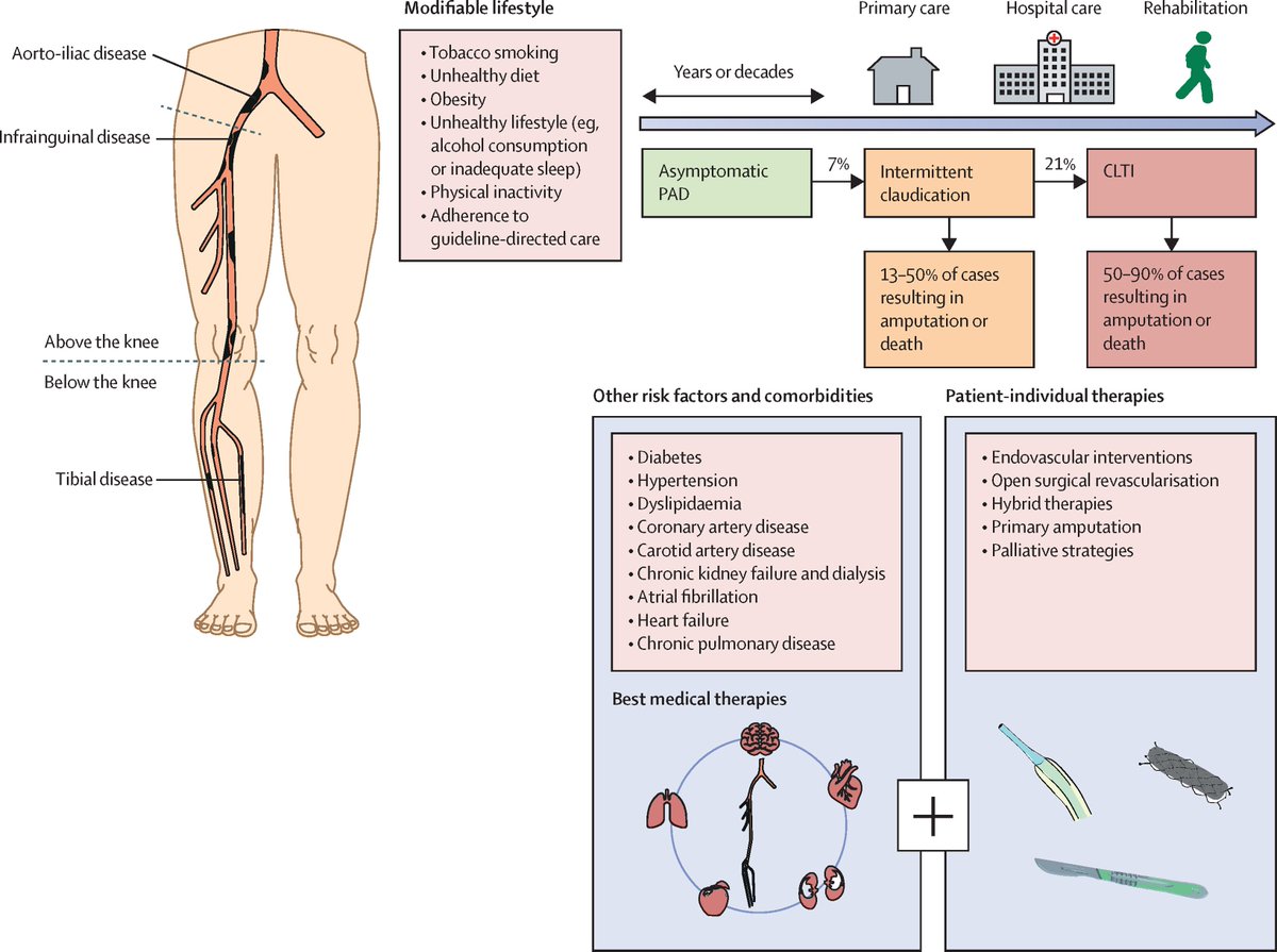 gbiondizoccai's tweet photo. Understanding peripheral arterial disease in the current era: a must-read review in The Lancet https://t.co/ZJrPjmEmc8 @TheLancet https://t.co/3kuZQGGbrZ
