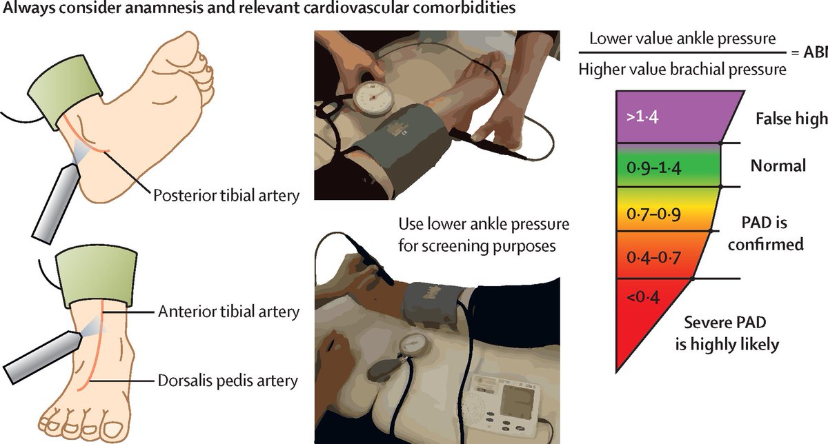 gbiondizoccai's tweet photo. Understanding peripheral arterial disease in the current era: a must-read review in The Lancet https://t.co/ZJrPjmEmc8 @TheLancet https://t.co/3kuZQGGbrZ