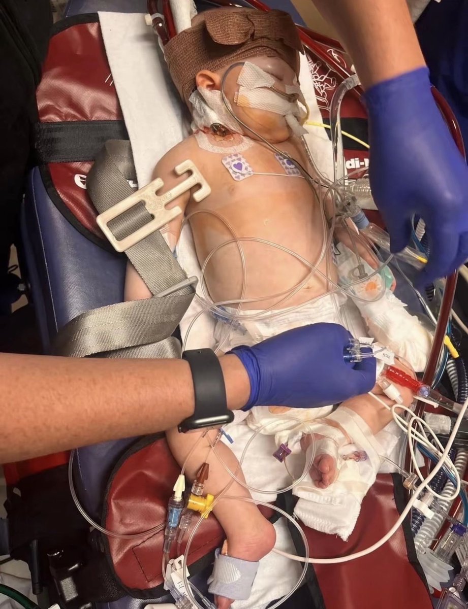 RTshen1's tweet photo. Aubrey’s story 

At just 4 months old, she developed severe RSV infection complicated by necrotizing pneumonia, PARDS &amp; cardiogenic shock

She initially required VA-ECMO. As her cardiac function improved but her lungs remained severely injured, she was transitioned to VV-ECMO https://t.co/0EYTdwYF0j