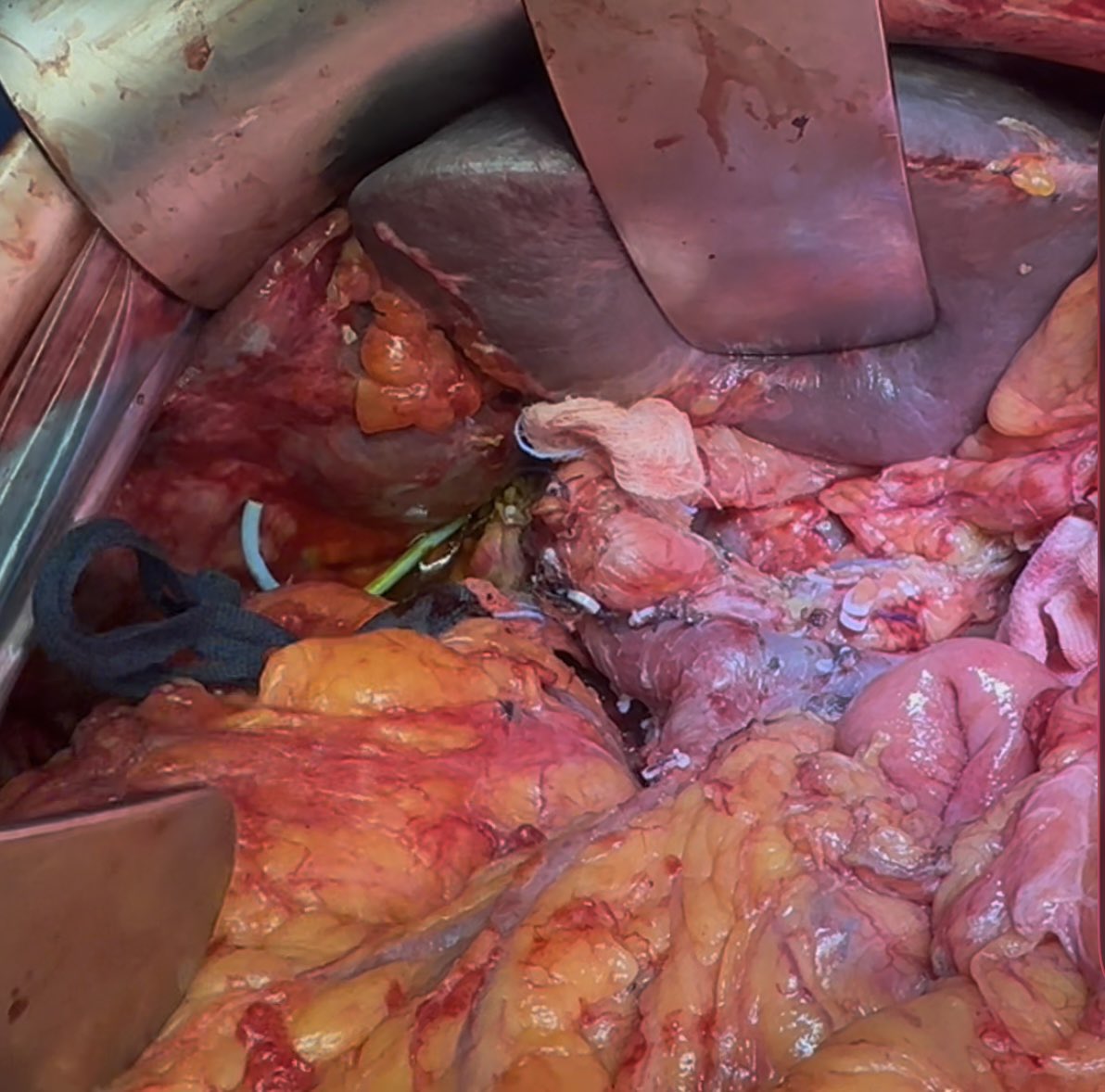 salo75's tweet photo. Technically challenging Whipple for Distal Biliary carcinoma arising on a previous choledoco-duodenal anastomosis done 30 years ago for a biliary iatrogenic lesion https://t.co/1WscL3S9g8