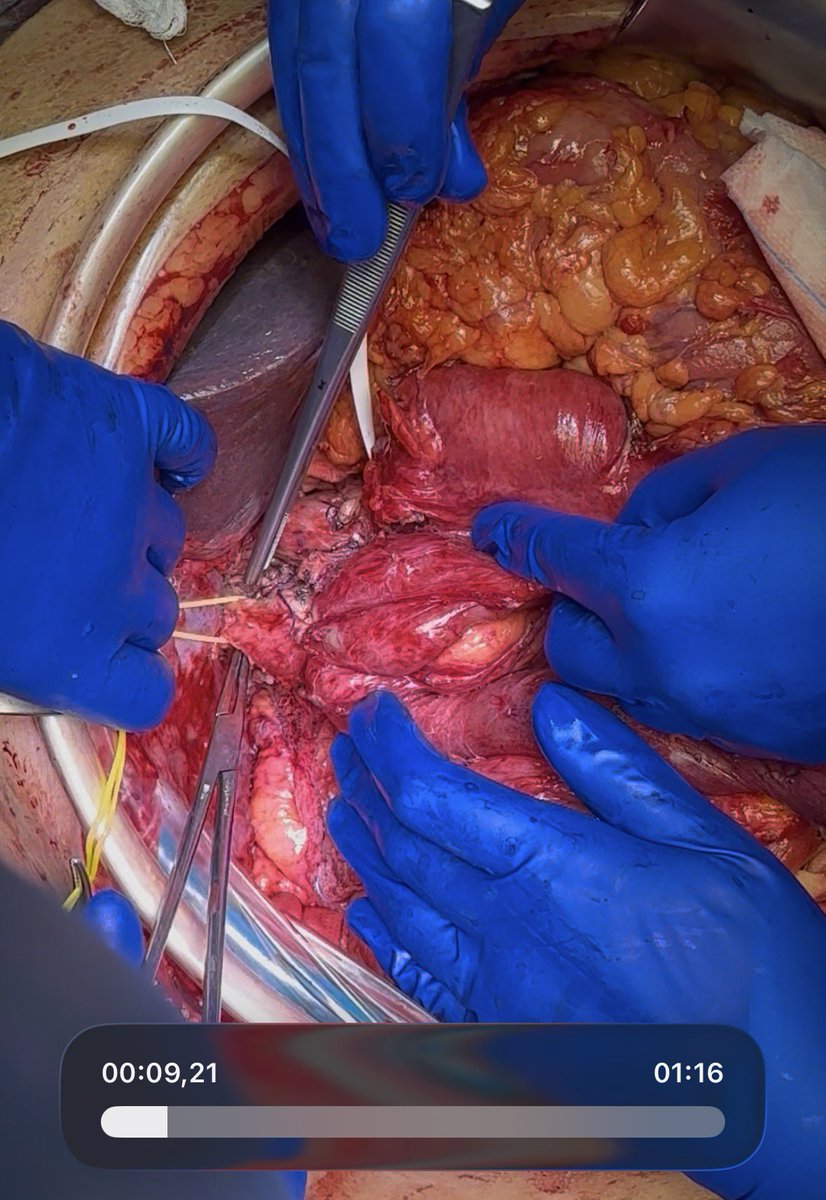 salo75's tweet photo. Technically challenging Whipple for Distal Biliary carcinoma arising on a previous choledoco-duodenal anastomosis done 30 years ago for a biliary iatrogenic lesion https://t.co/1WscL3S9g8