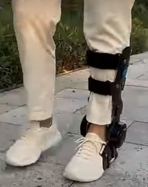 Suzierizzo1's tweet photo. It’s become obvious that Trump is using a Functional Electric Stimulation (Neuroprosthetics) device on his right leg after a stroke last year. They help lift the foot &amp; improve walking. These devices have a sensor you can tap on your leg to make it lift your foot &amp; move. https://t.co/f0CxEmtHgR