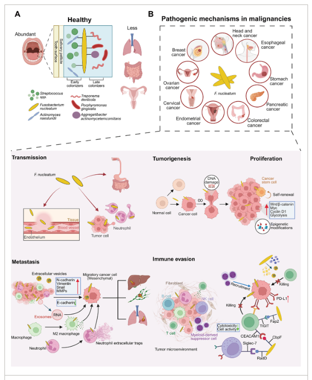 DrGrahamLJ's tweet photo. Everything you could want to know about F.nucleatum.

In short, F.nucleatum is a common gum disease bacterium species which escapes the mouth and kills humans, slowly.

(Other lethal gum disease bacteria species are available.)

👇👇👇👇
Yang et al 2025
https://t.co/f8DRjSbl7O https://t.co/IhKPtmwgQ9