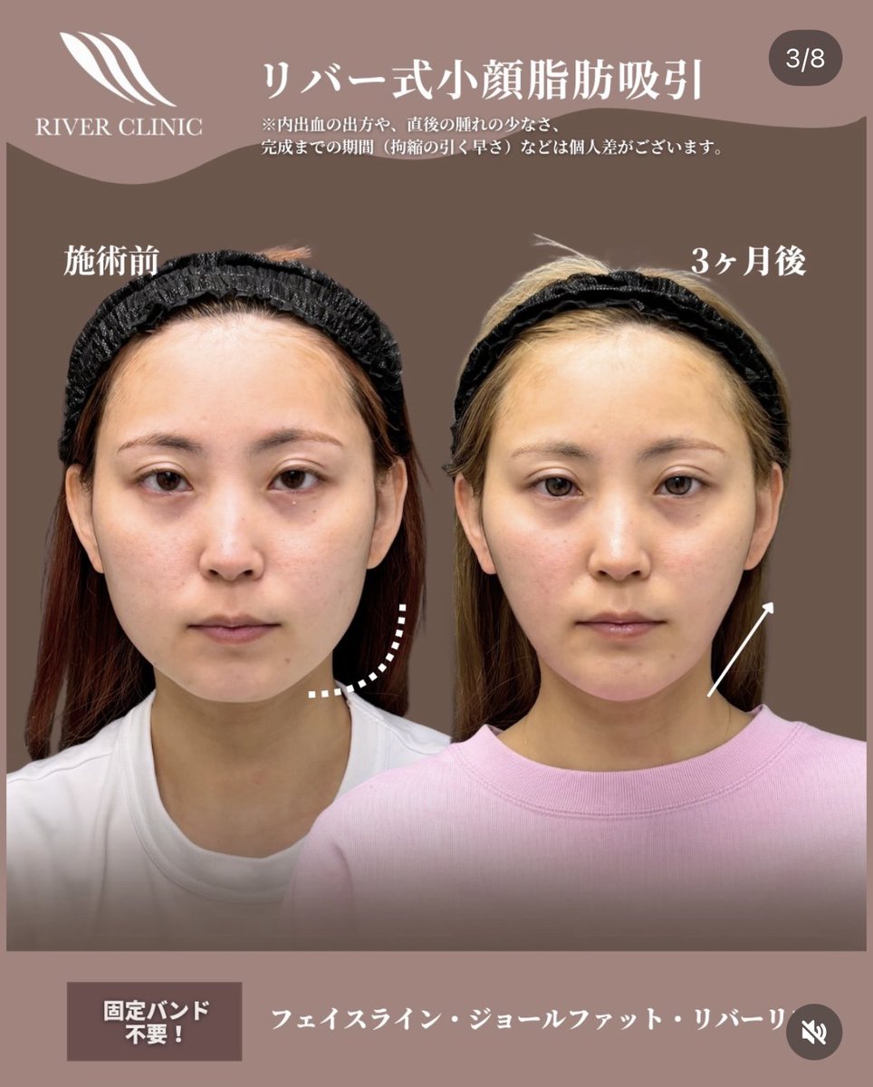 _RIVERCLINIC's tweet photo. この変化は、脂肪吸引でしか得られない。

脂肪吸引の完成は半年後くらい。
でも実際は、1ヶ月くらいから「かなり変わった」と実感する方も多いです。

そして3ヶ月後にさらにスッキリして、

「1ヶ月の時点でも十分スッキリしてたけど、あれでもまだダウンタイム中だったんですね」

と言われることもよくあります。

この症例もまさにそれ。

術前 → 1ヶ月 → 3ヶ月。

脂肪吸引は直後だけじゃなく、時間が経つほど輪郭が洗練されていく。

だから僕は、3ヶ月、半年後の完成形まで想像して脂肪を取っています。

顔の脂肪吸引5,000件以上。
輪郭を変えたいなら、戸田に任せてください。

#riverclinic #リバークリニック #戸田貴之　#リバー式小顔脂肪吸引