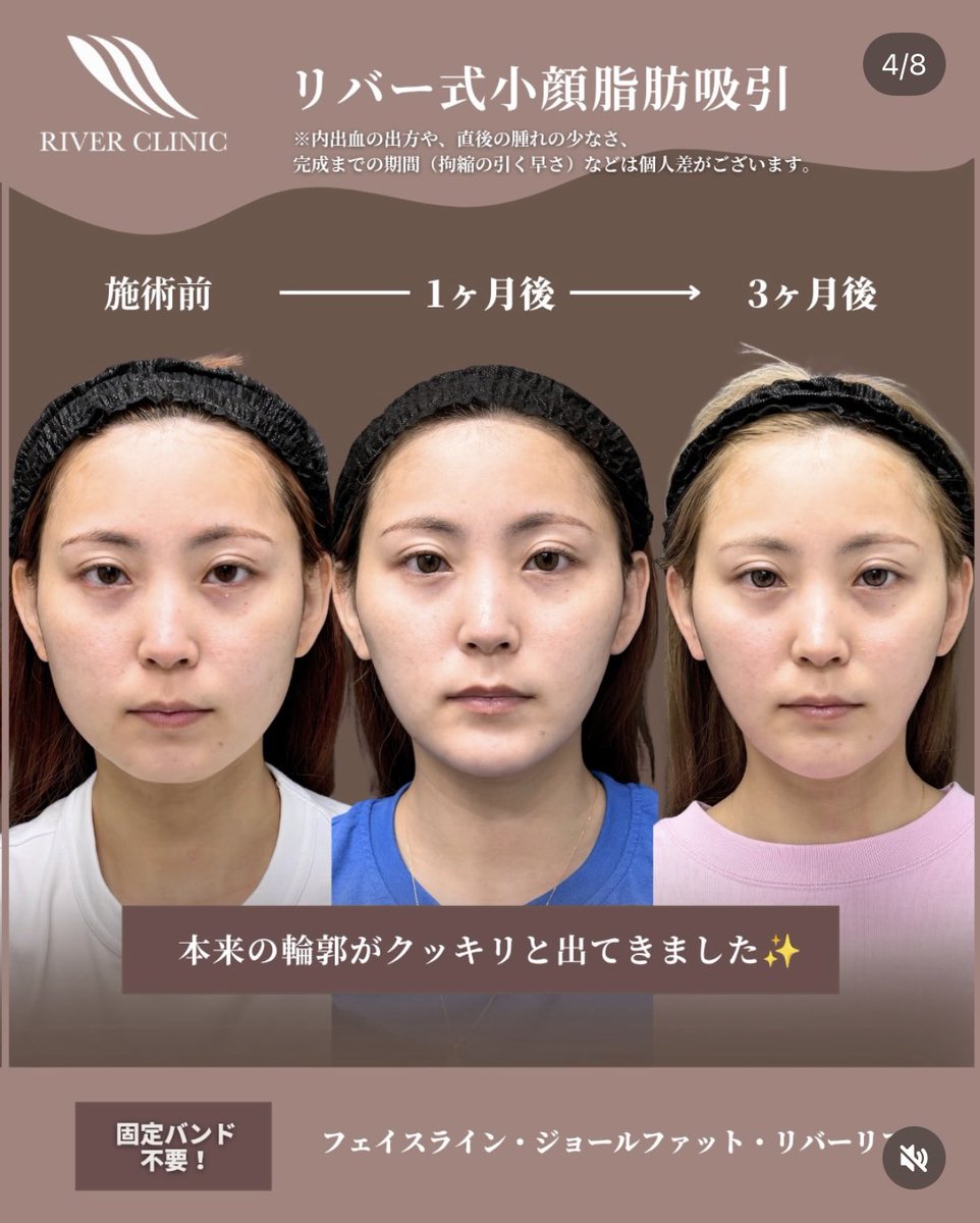 _RIVERCLINIC's tweet photo. この変化は、脂肪吸引でしか得られない。

脂肪吸引の完成は半年後くらい。
でも実際は、1ヶ月くらいから「かなり変わった」と実感する方も多いです。

そして3ヶ月後にさらにスッキリして、

「1ヶ月の時点でも十分スッキリしてたけど、あれでもまだダウンタイム中だったんですね」

と言われることもよくあります。

この症例もまさにそれ。

術前 → 1ヶ月 → 3ヶ月。

脂肪吸引は直後だけじゃなく、時間が経つほど輪郭が洗練されていく。

だから僕は、3ヶ月、半年後の完成形まで想像して脂肪を取っています。

顔の脂肪吸引5,000件以上。
輪郭を変えたいなら、戸田に任せてください。

#riverclinic #リバークリニック #戸田貴之　#リバー式小顔脂肪吸引