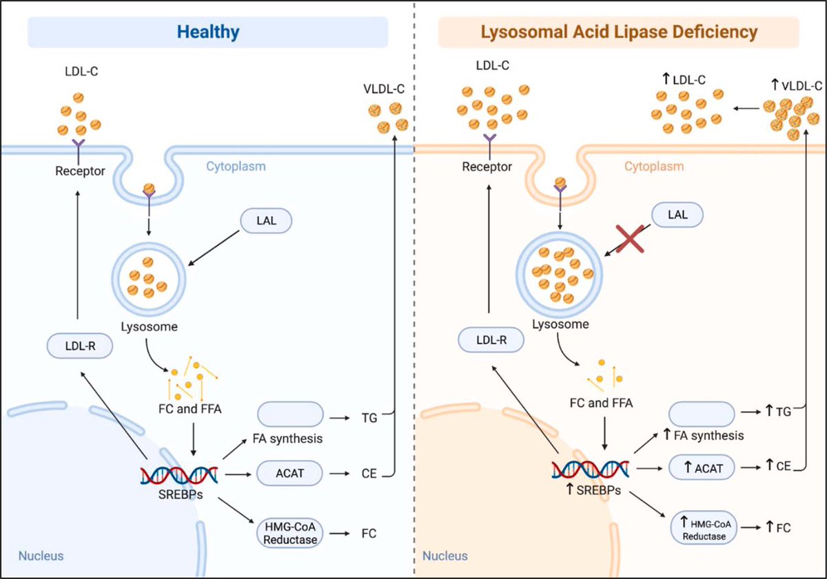 LeonieDupuisMD's tweet photo. The #NLAFall Lipid Scholar Case Discussion is putting unusual lipid disorders into clinical context.
Dr. Sierra Sullivan presented a case of LAL-D which is underrecognized because it manifests very similarly to heterozygous FH.
Figure from Sheth et al. JACC: Case Reports 2023 https://t.co/GQ85LHEgYN