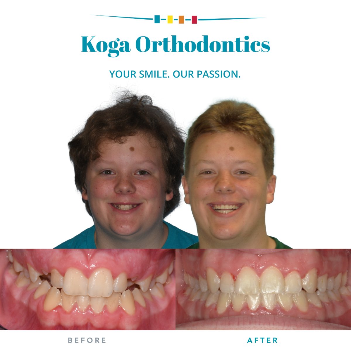 kogaortho's tweet photo. Braces came off for Miller, who now smiles freely with friends and family everywhere. This patient captures confidence in every photo, celebrating a bright, open smile.

#KogaOrtho #bracesbeforeandafter https://t.co/phk6YcBKTz