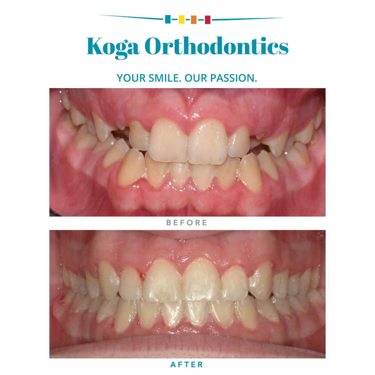 kogaortho's tweet photo. Braces came off for Miller, who now smiles freely with friends and family everywhere. This patient captures confidence in every photo, celebrating a bright, open smile.

#KogaOrtho #bracesbeforeandafter https://t.co/phk6YcBKTz