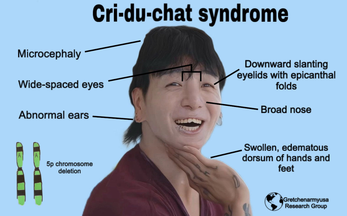 gretchenarmyusa's tweet photo. Hey there! 😄
As part of my studies, I am researching Cri-du-chat syndrome. 
I have created a simple diagram illustrating all the physical characteristics of a child with 5p chromosome deletion. https://t.co/0JewsLuNT9