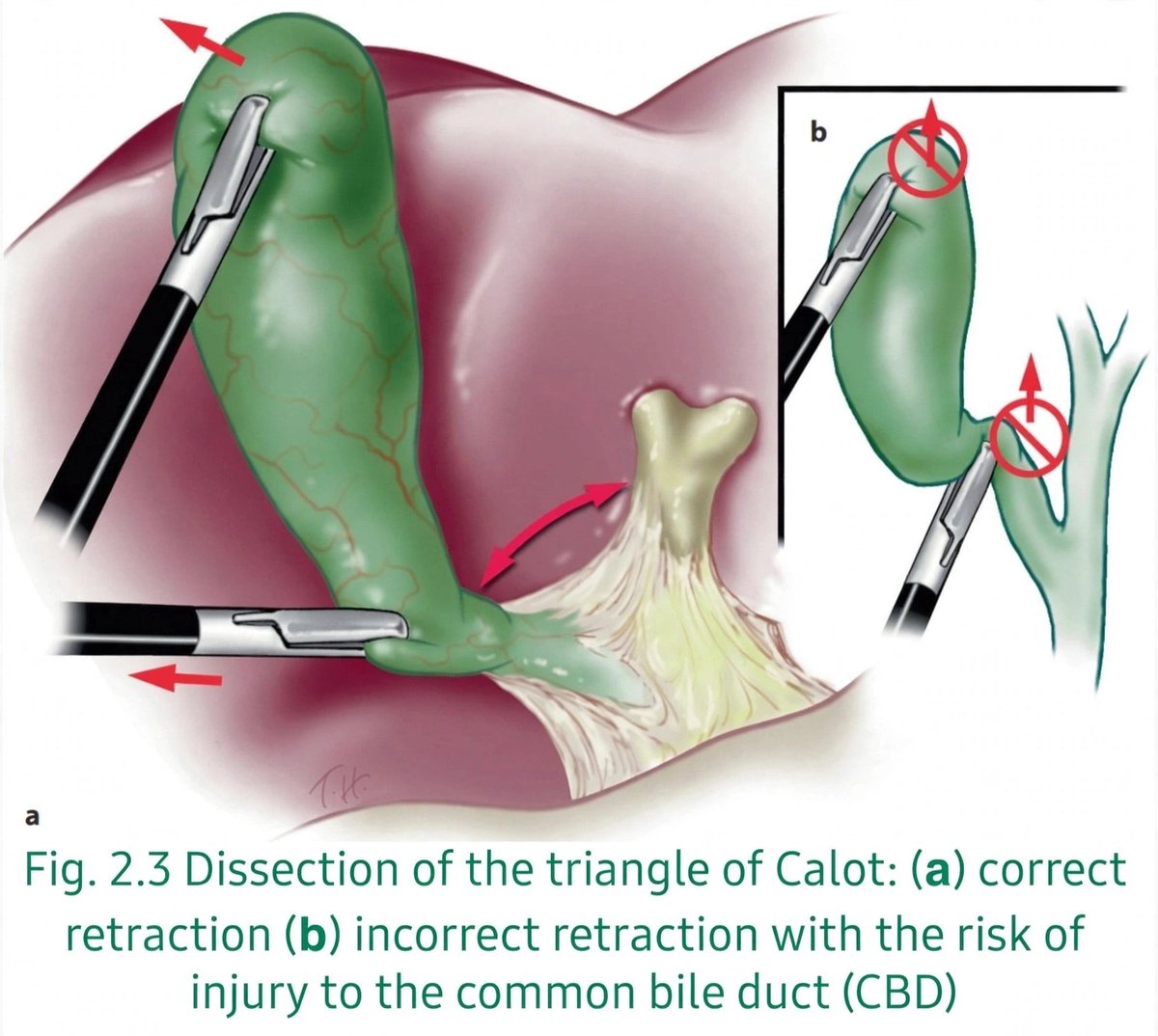 DrJStewart_GS's tweet photo. 🔑 Retraction is dissection

✅ Correct (a): Fundus up ⬆️ + infundibulum lateral ➡️ Opens Calot's triangle and gives you a real Critical View of Safety

❌ Wrong (b): Pulling the infundibulum up ⬆️ Tents the CBD right into line with the cystic duct → classic bile duct injury https://t.co/jzGz9aMI0E