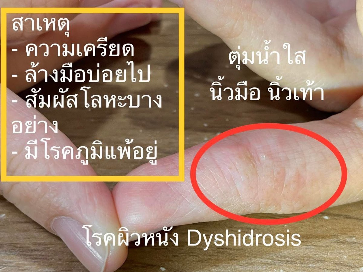 mutamumumu's tweet photo. โรคผิวหนังชนิด มีตุ่มน้ำใสที่นิ้วมือนิ้วเท้า
ทางแพทย์เรียกว่า Dyshidrosis มักเข้าใจกันผิดว่าเกิดจากการแพ้เหงื่อ ความจริงแล้วไม่ใช่ค่ะ
อะไรสาเหตุที่กระตุ้นให้เกิดอาการ?
1.  ความเครียด
2.  ล้างมือบ่อยไป และอาจจะเป็นสบู่ที่ล้างแรงเกินไป
 3.  แพ้สัมผัสโลหะบางอย่างเช่นโคเบาหรือนิกเกิล
4.  มีโรคภูมิแพ้ทางผิวหนังอยู่ก่อน

การรักษา
ส่วนตัวเราใช้ครีมตัวนี้ทาอาการคันและตุ่มน้ำใสๆยุบลงจริงๆ

พิกัดครีมที่เราใช้นะคะ
https://t.co/77r5cp6ySE