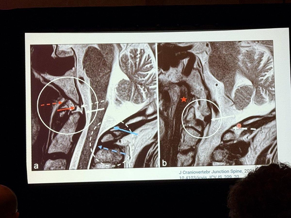 The_ASSR's tweet photo. Unstable craniocervial spine fractures at #WNRS26 with @Charles_Li_MD with a great anatomy review and interesting cases!
@radiology_ninja @KSeifertMD https://t.co/TrPFZwOD5A