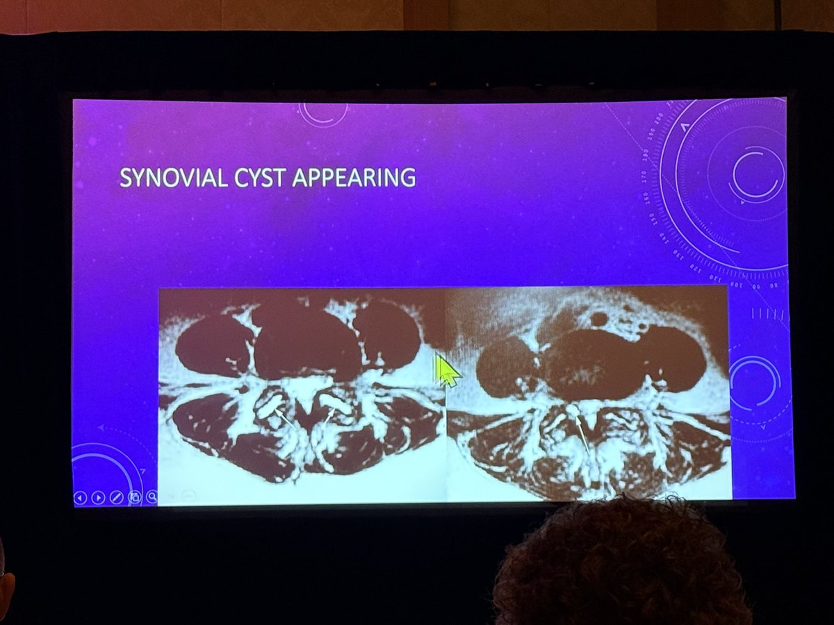 The_ASSR's tweet photo. Dynamic spine imaging at #WNRS26 with Dr. Steve Pollei showing how spine imaging can change with changes in positioning
@radiology_ninja @KSeifertMD https://t.co/nC1YII83Df