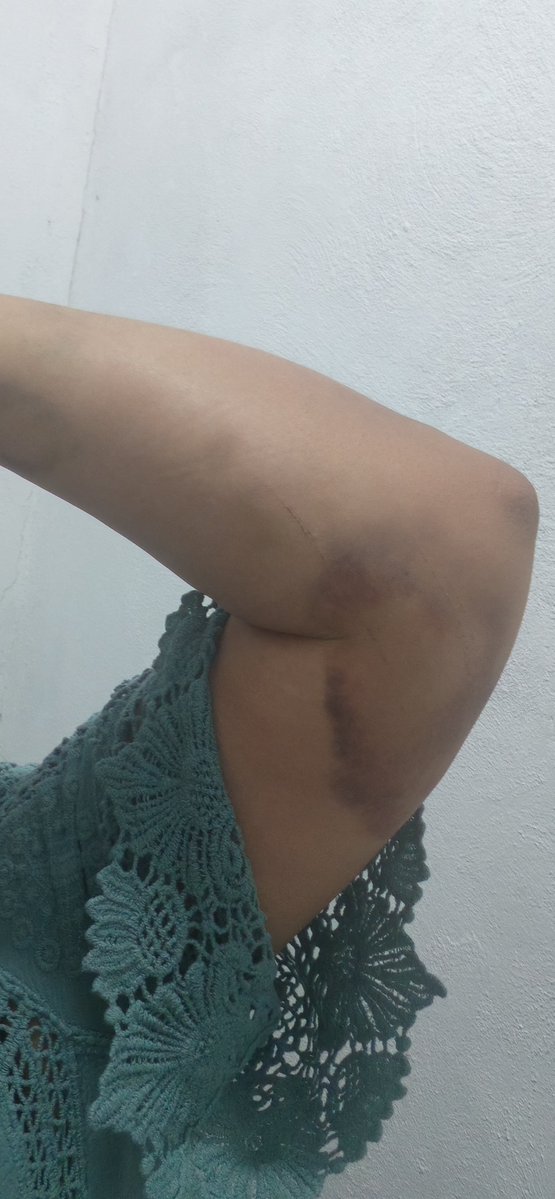 kenai09's tweet photo. Soy la única enamorada que ve un corazón en mi moretón?

Ya va mejorando al menos ese... https://t.co/rbfqVlwKdS