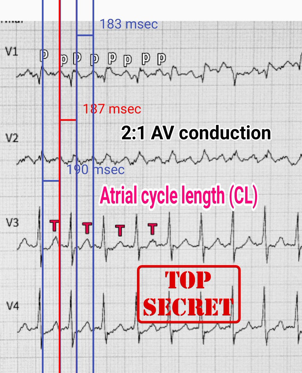 DrRazi4's tweet photo. #ECG shows regular NCT with HR ~ 171bpm:

1. P>QRS or A>V in 2:1 conduction
2. +P wave seen in V1
3. - P wave seen Lead 2 with on P wave embedded in QRS (Bix's rule)
4. Atrial rate, CL and P wave oscillation beyond isoelectric line suggests flutter waves.

🔺2:1 Typical CCW AFL https://t.co/yurP3wOjbX