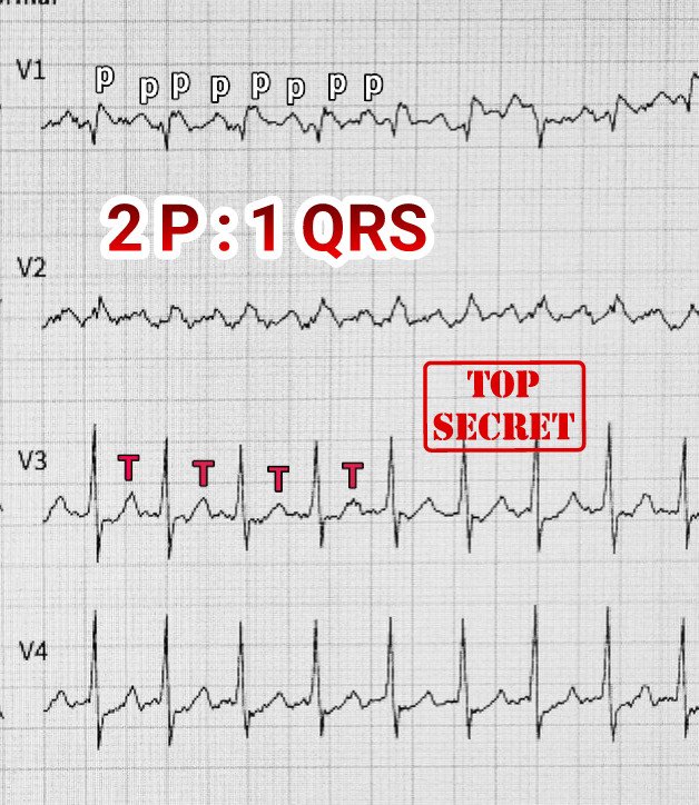 DrRazi4's tweet photo. #ECG shows regular NCT with HR ~ 171bpm:

1. P>QRS or A>V in 2:1 conduction
2. +P wave seen in V1
3. - P wave seen Lead 2 with on P wave embedded in QRS (Bix's rule)
4. Atrial rate, CL and P wave oscillation beyond isoelectric line suggests flutter waves.

🔺2:1 Typical CCW AFL https://t.co/yurP3wOjbX