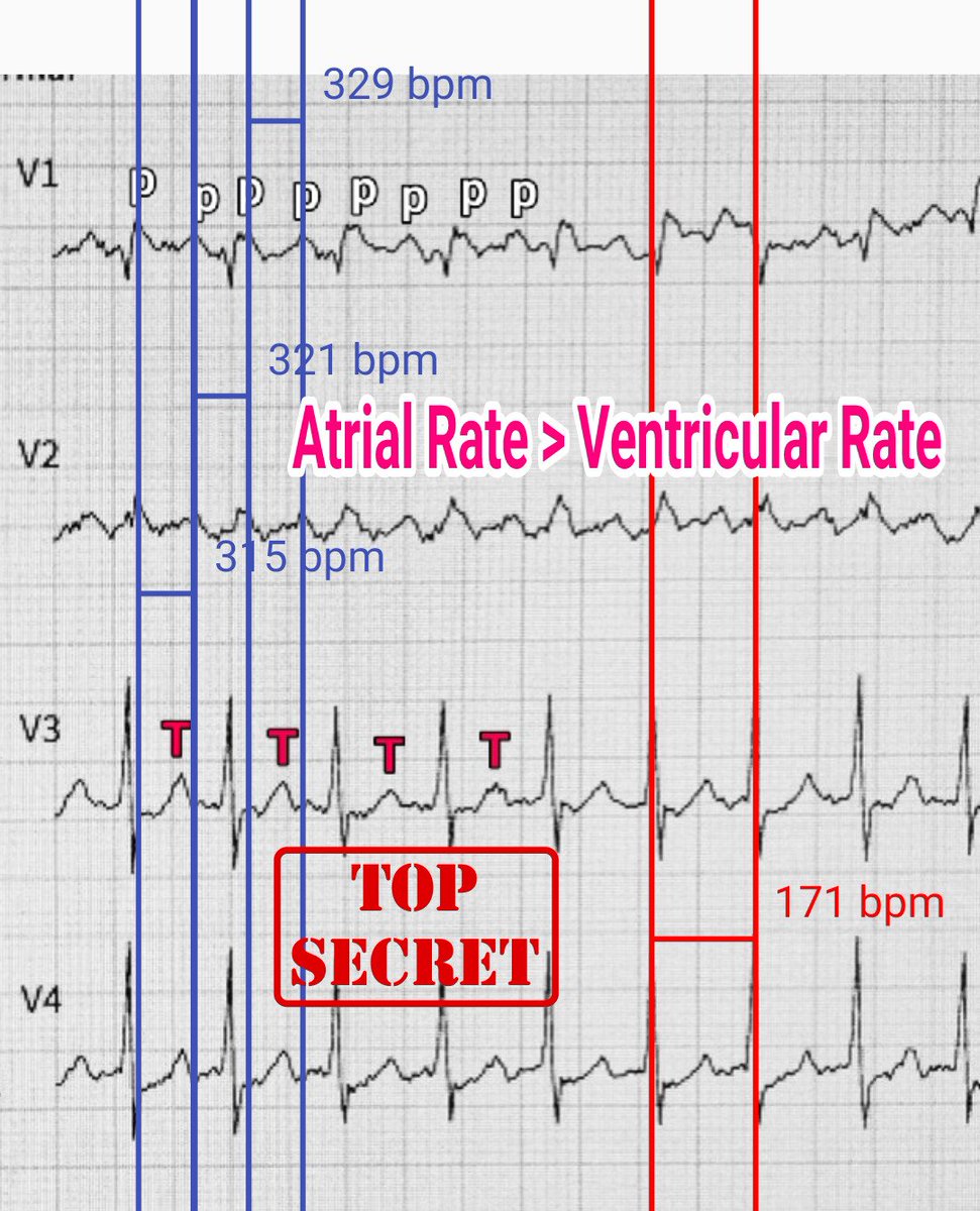 DrRazi4's tweet photo. #ECG shows regular NCT with HR ~ 171bpm:

1. P>QRS or A>V in 2:1 conduction
2. +P wave seen in V1
3. - P wave seen Lead 2 with on P wave embedded in QRS (Bix's rule)
4. Atrial rate, CL and P wave oscillation beyond isoelectric line suggests flutter waves.

🔺2:1 Typical CCW AFL https://t.co/yurP3wOjbX