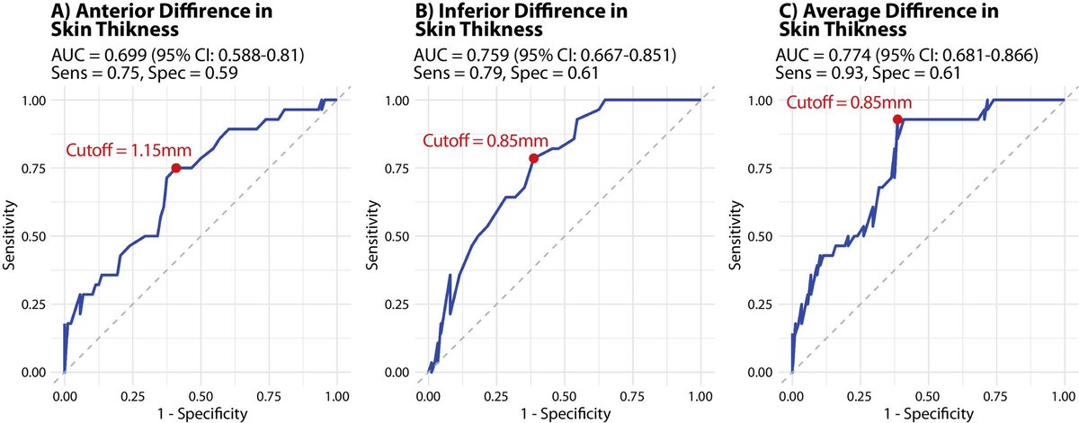 TamerRefaatMD's tweet photo. Excited to share our new work in the Red Journal @IJROBP!

Novel dosimetric &amp; mammographic predictors of breast lymphedema after breast-conserving therapy.

📖 Free access through Nov 18:
https://t.co/GCFMBOt1ou

#BreastCancer #RadOnc @ASTRO_org https://t.co/ghyH2HQO0D