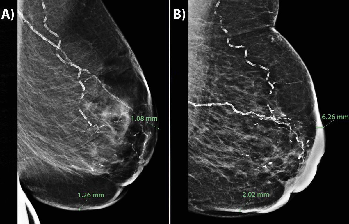 TamerRefaatMD's tweet photo. Excited to share our new work in the Red Journal @IJROBP!

Novel dosimetric &amp; mammographic predictors of breast lymphedema after breast-conserving therapy.

📖 Free access through Nov 18:
https://t.co/GCFMBOt1ou

#BreastCancer #RadOnc @ASTRO_org https://t.co/ghyH2HQO0D