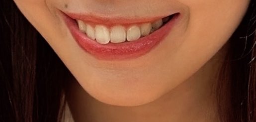 yohaku_zero_'s tweet photo. 歯並びはそんな悪くないんだけど、最近前歯だけガタつき気になるな〜でもこれに100万とか使えないな〜と思ってたら、おんなじような症例見つけて神🥹✨

1年以内だし30万とかで済むならありすぎる、
カウセ無料だし一旦話聞いてみるか🙂‍↕️ https://t.co/QRRZpN3vaO