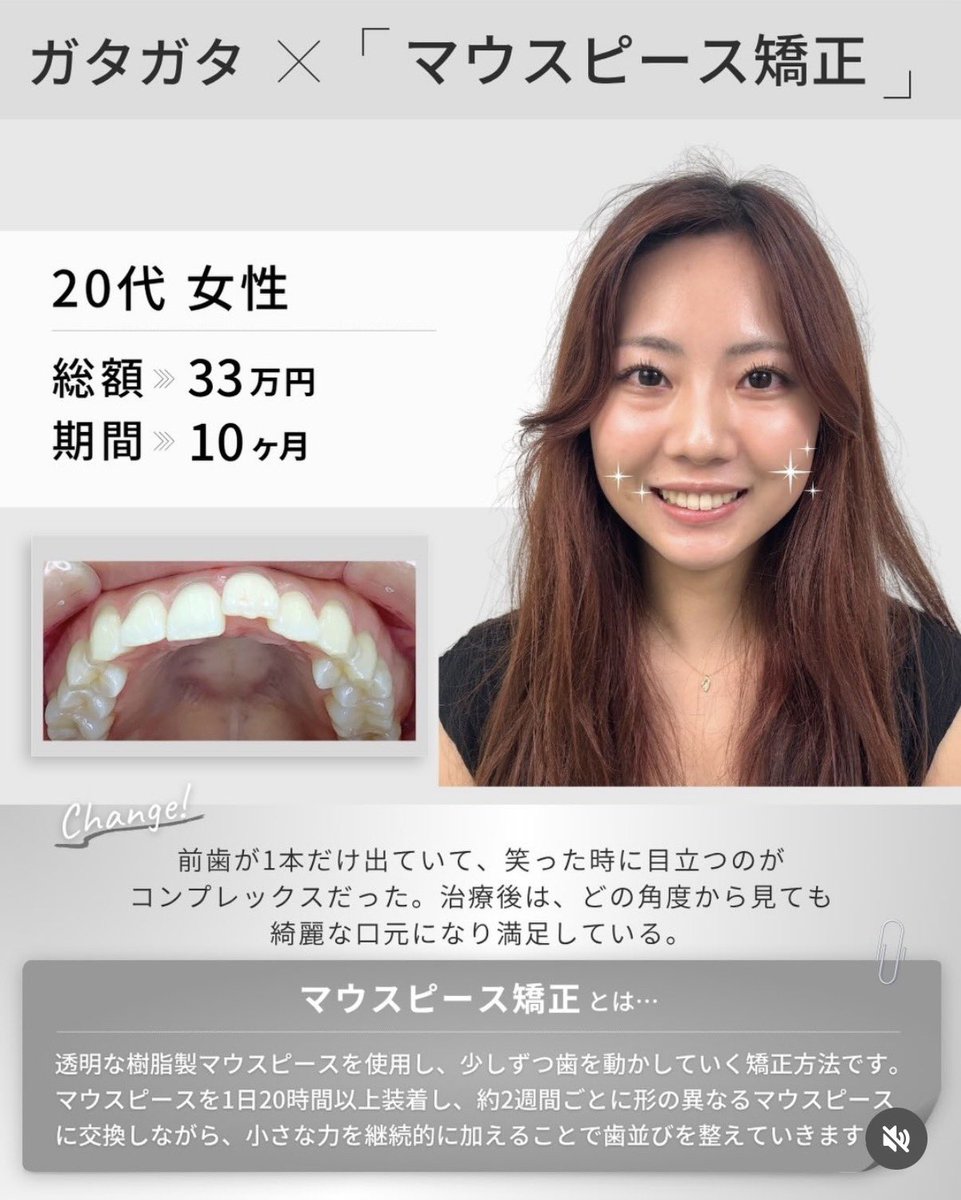 yohaku_zero_'s tweet photo. 歯並びはそんな悪くないんだけど、最近前歯だけガタつき気になるな〜でもこれに100万とか使えないな〜と思ってたら、おんなじような症例見つけて神🥹✨

1年以内だし30万とかで済むならありすぎる、
カウセ無料だし一旦話聞いてみるか🙂‍↕️ https://t.co/QRRZpN3vaO