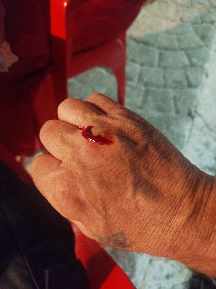 AnimauRevolts's tweet photo. Eu odeio violência mas sei me defender. Um filho da puta tentou me agredir - por causa de uma camiseta e um adesivo de Lula e do PT - mas eu eu o deitei no soco, caralho! Isso é a marca de um dente desse merda, porra! Tá caído lá, na rua 4, o bosta... https://t.co/peFxz1qBTt