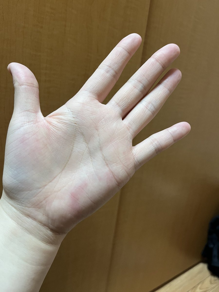 haru05283's tweet photo. 昨日手を噛まれてまだ若干痺れてる笑
でも、腫れはほぼ引いてて悲しい…😢 https://t.co/7QKqlfhkEX