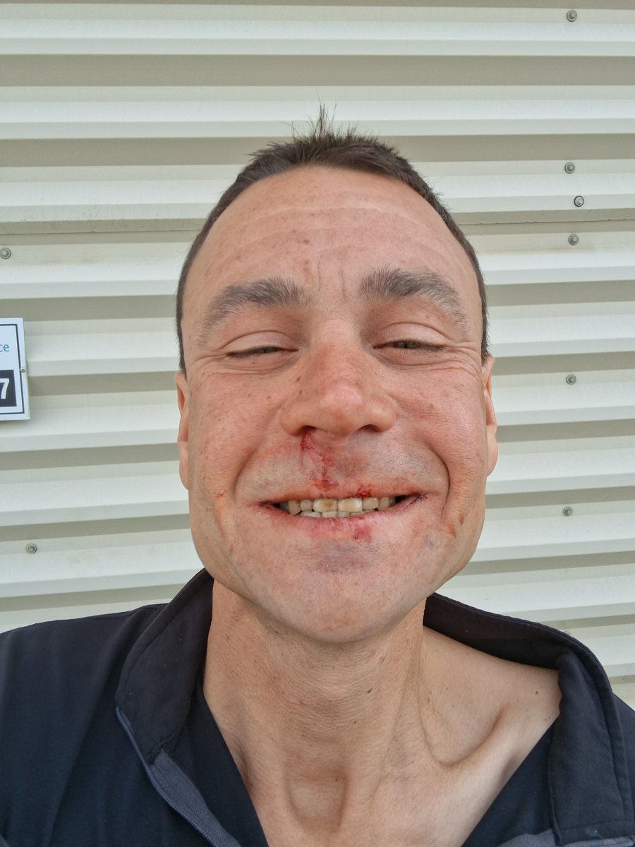 SpeBDbeezknees's tweet photo. Enjoy Some Spe-Ness. Fake Wounds for Fake folks, I call this series of #Selfies
I was not harmed at all (none care 😂) Simply elected to make the best of a nothing, failed attempt at worthless mess #X7 #FreeSpe #BonneNuit https://t.co/I6ODfqFmer