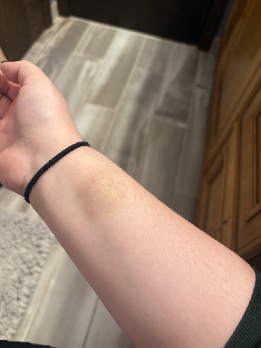 paperbageraa's tweet photo. heavily enjoying the progression of my sfx makeup practice i love how inconspicuous it is

warning fake bruises #shed https://t.co/5TM2Z6uWEJ