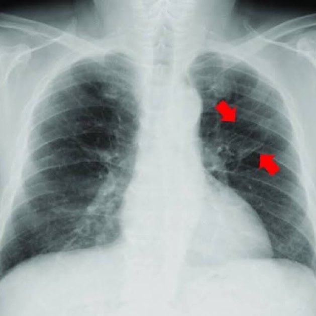 SciNatureNews's tweet photo. JUST IN🚨: A fungus that can grow inside the lungs and “eat the human body from inside” is spreading rapidly across the planet. https://t.co/Wi0ynjlrDH