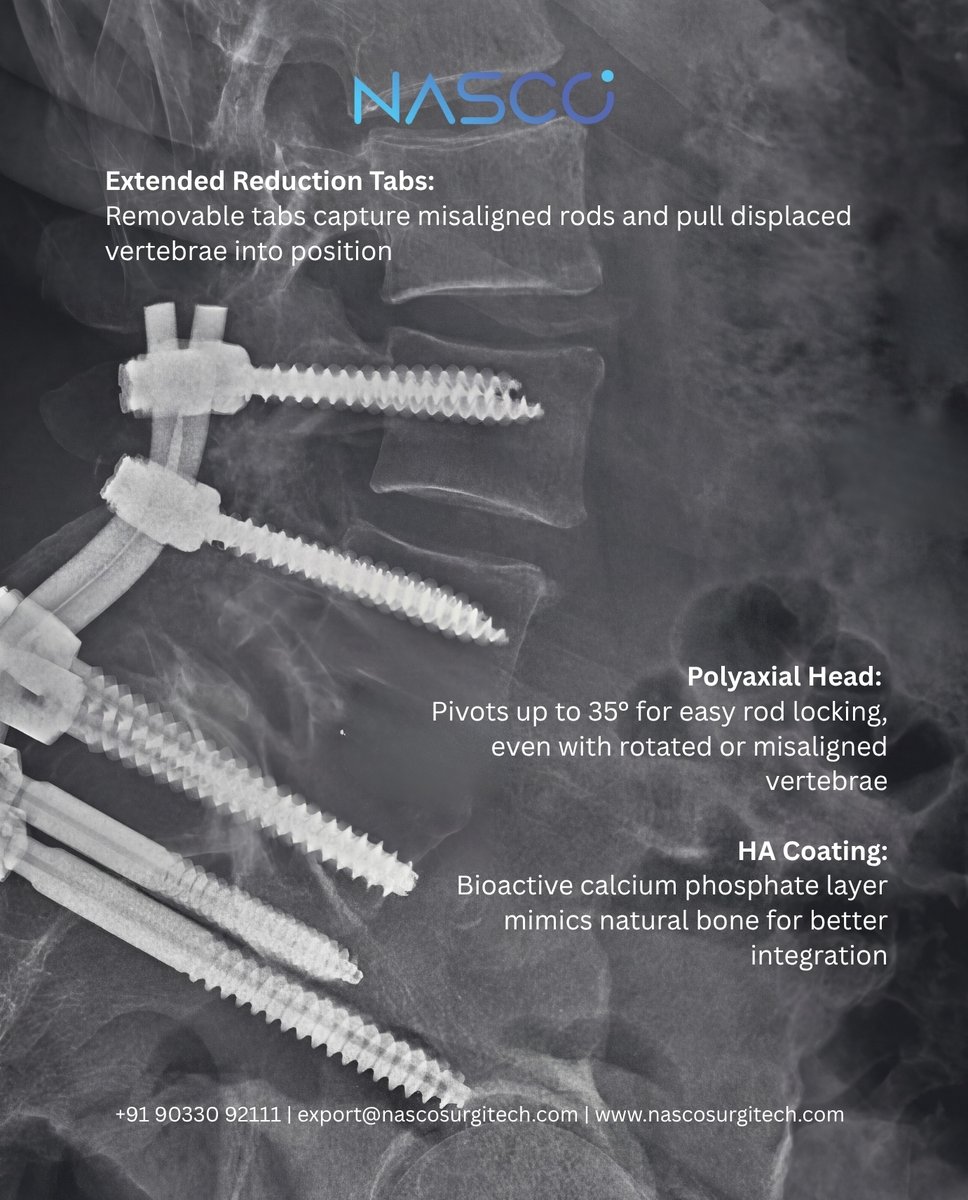 NascoSurgitech's tweet photo. 🔩 Meet the STAR Poly Reduction Screw – H.A. Coated

✅ Reduction tabs capture misaligned rods
✅ 35° polyaxial head for easy locking
✅ H.A. coating = faster bone integration 🦴

📏 5.5–6.5mm | 30–50mm
🌐 https://t.co/ki1g6Ki9PK

#SpineSurgery #PedicleScrew https://t.co/gvOLEMO5ck