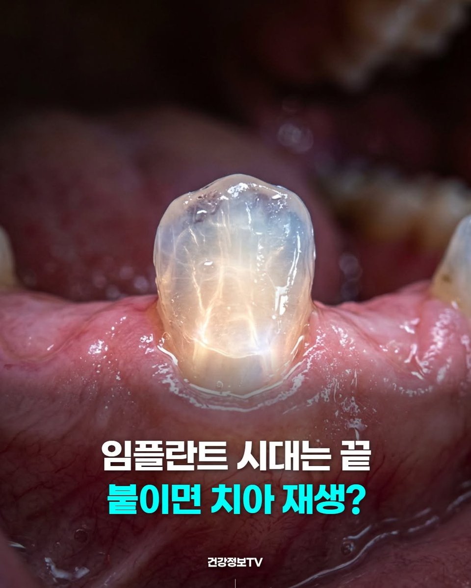thinkingtree413's tweet photo. 임플란트 시대 끝났다는 국내 연구진 소식. 

KIST랑 서울대 공동 연구팀이 잇몸에 붙이기만 해도 
치아 내부 조직이 스스로 자라나는 '생리활성 패치'를 개발함.

금속 박는 임플란트랑 다르게 
휴면 상태인 줄기세포를 자극해서 
상아질, 법랑질, 신경까지 통째로 재형성하는 원리임. 

동물 실험에서 이미 자연 치아급 강도랑 
신경 반응성까지 검증 끝났고 인체 임상 앞두고 있음.
