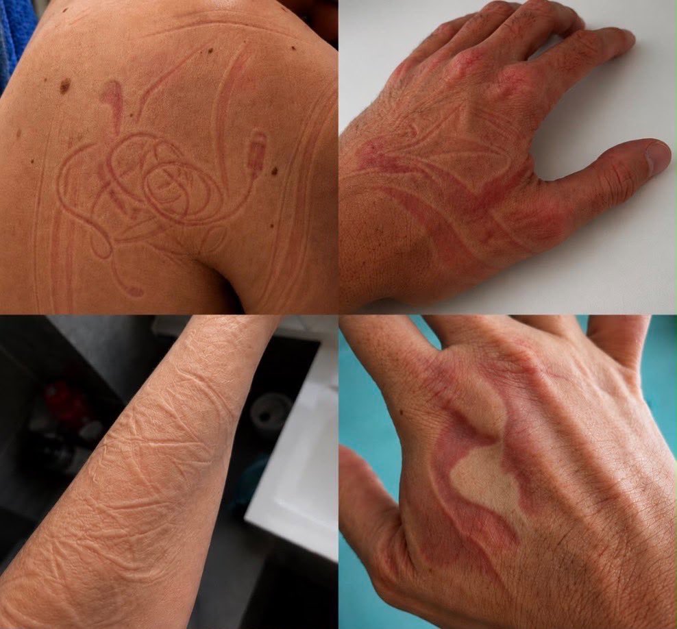 Drballer01's tweet photo. Can someone please explain this, Why do we get marks on our bodies after a nap but never when we sleep at night?🤔👀 https://t.co/r1xcvfSUCb