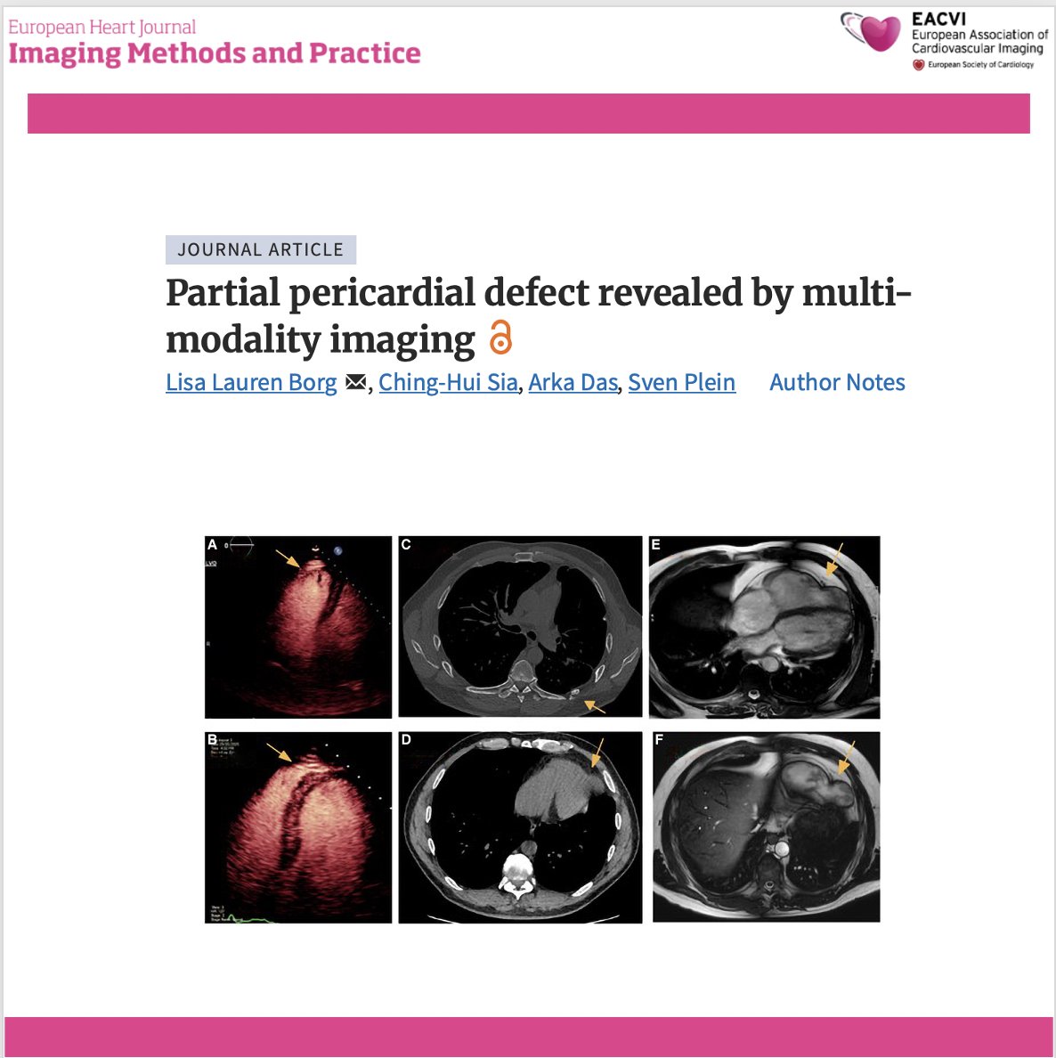 EHJIMPEiC's tweet photo. 🫀 Could a traumatic partial pericardial defect be hiding in plain sight?
A fascinating multimodality imaging case highlights how echocardiography, CT and cardiac MRI uncovered an acquired partial pericardial defect with right ventricular apical herniation in a patient presenting with intermittent chest pain years after major thoracic trauma.

🔍 Key findings:
✅ Stress echocardiography showed an apparently dilated right ventricle with an aneurysmal-appearing apex, raising suspicion for structural heart disease.
✅ Chest CT demonstrated loss of the pericardial contour at the RV apex in the region of previous left-sided rib fractures.
✅ Cardiac MRI confirmed a partial pericardial defect with herniation of the RV apex, while showing preserved RV size, systolic function and normal myocardial tissue characteristics.
✅ As the patient remained clinically stable without evidence of progressive herniation or ventricular dysfunction, conservative management with serial imaging was chosen instead of surgery.

💡 Clinical takeaway:
Not every "RV aneurysm" is myocardial disease. Multimodality imaging is essential to distinguish pericardial defects from cardiomyopathies and can reveal rare acquired complications of previous chest trauma, preventing unnecessary interventions.

📖 https://t.co/8tQ6IsfafZ

#CardioX #MultimodalityImaging #CardiacMRI #CardiacCT #Echocardiography #PericardialDisease #RightVentricle #CardiacImaging #Cardiology #OpenScience