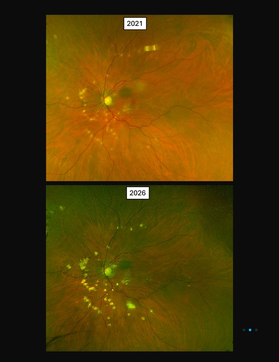 RetinaSERV's tweet photo. La importancia del fondo de ojo en la MNV “miópica”.
#Miopia #MNV #PIC #Retina #SERV https://t.co/QhweXEwKZC