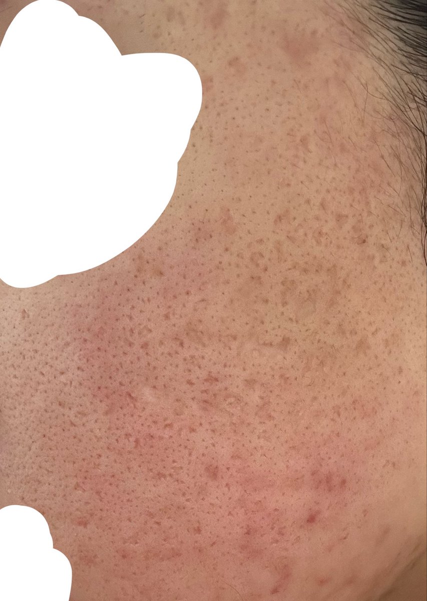 zawamoli's tweet photo. ⚠️閲覧注意  苦手な方スクロール⚠️
勇気を出してupします😭以前よりカメラの性能が上がったことも大きいですが、クレーターや毛穴が酷く…美容医療を本格的に検討しています。
中々踏み出せないのでこの肌に効果のありそうな治療等、些細な事でも教えてください😭力を貸して下さいよろしくお願いします https://t.co/DZH1gJ07Pe