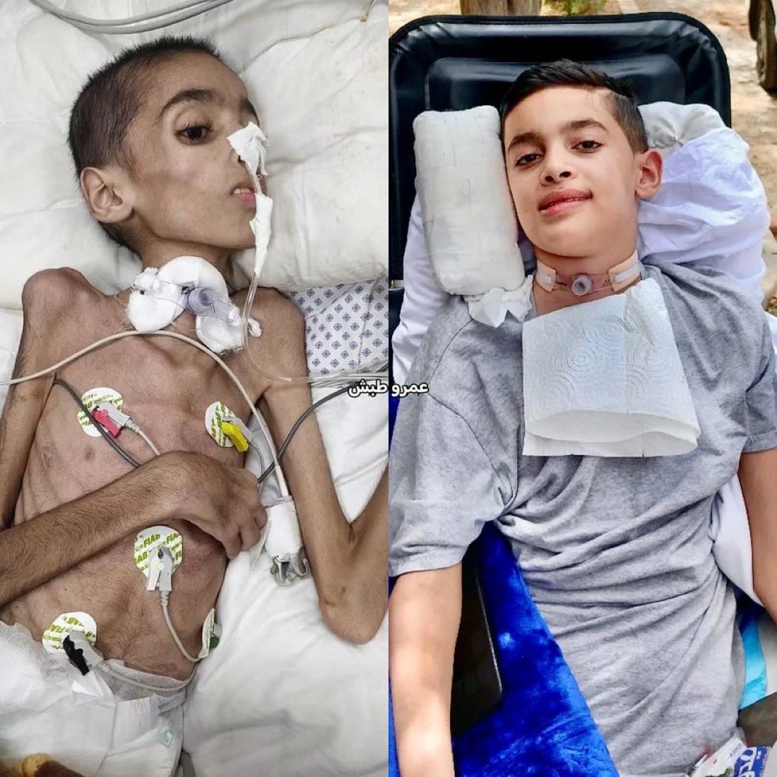 AHMED_ABUHAMAD_'s tweet photo. سبحان من يحيي العظام وهي رميم ! 🤲

​معجزة حقيقية للطفل إيهاب (12 عاماً) بعد أن كان بين الحياة والموت. بفضل الله ثم الرعاية الطبية، بدأ إيهاب في التعافي بشكل مذهل. الحمد لله على سلامته، ونسأل الله أن يتمم شفاءه على خير❤️ https://t.co/v9DMzOTGdH