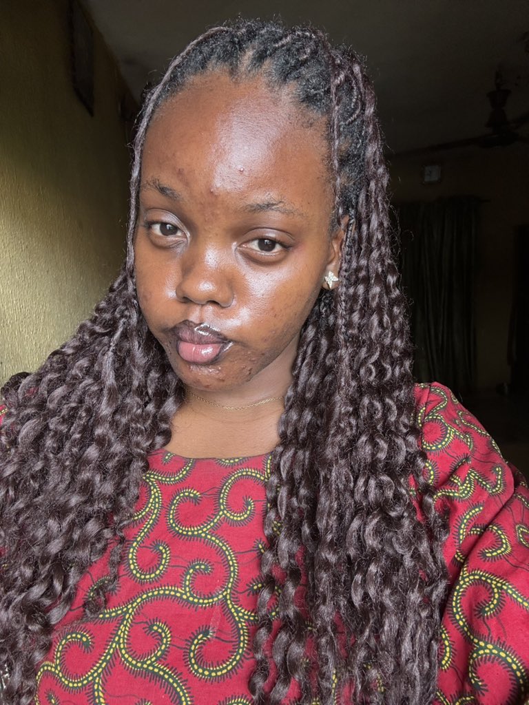 NwakozorE's tweet photo. I almost didn’t go to church because of my acne. I’m happy I didn’t let it stop me🤭. Happy Sunday peeps❤️ https://t.co/1wwV5H89J4