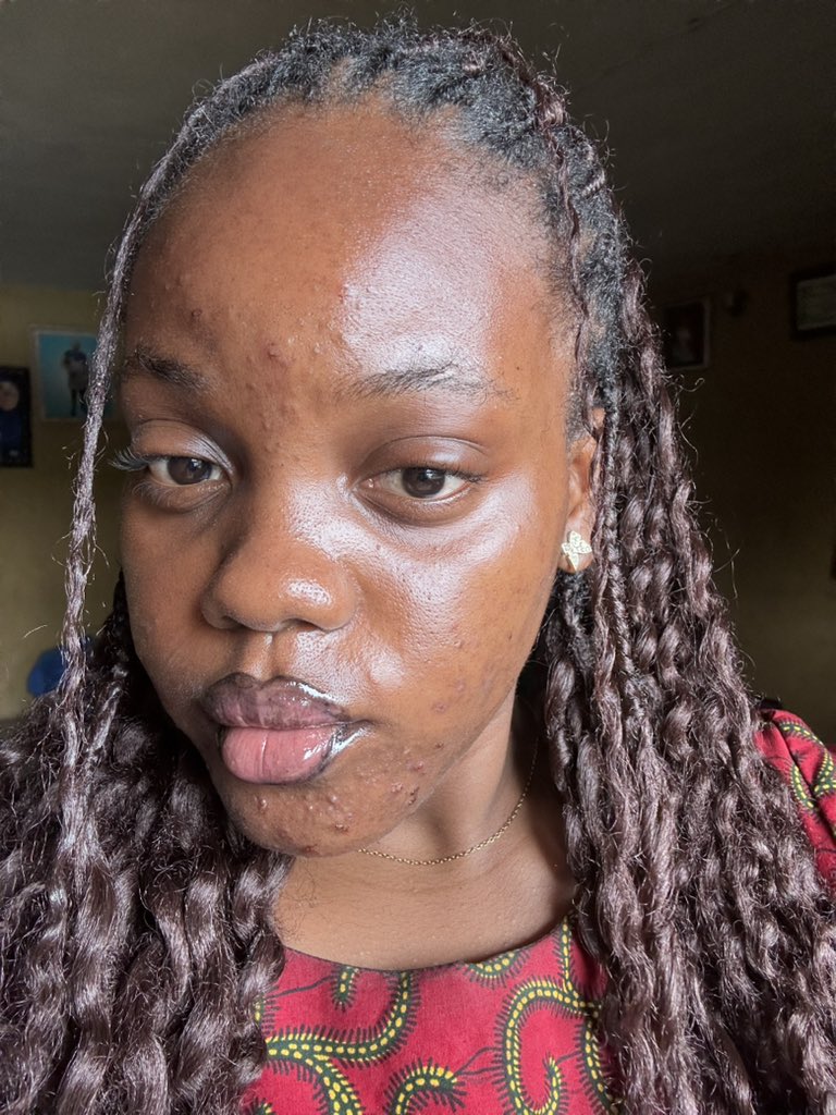 NwakozorE's tweet photo. I almost didn’t go to church because of my acne. I’m happy I didn’t let it stop me🤭. Happy Sunday peeps❤️ https://t.co/1wwV5H89J4