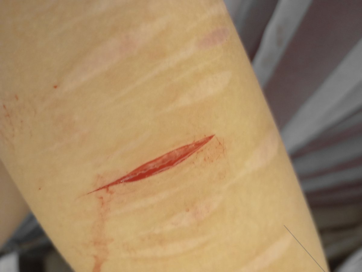 mugurelll_'s tweet photo. One swipe btw 
!! SFX MAKEUP PRACTICE!! 
!! ALL FAKE!! 
#sfxmakeup #shedtwt #fake #ouchietwt https://t.co/OQWj91O8Ay