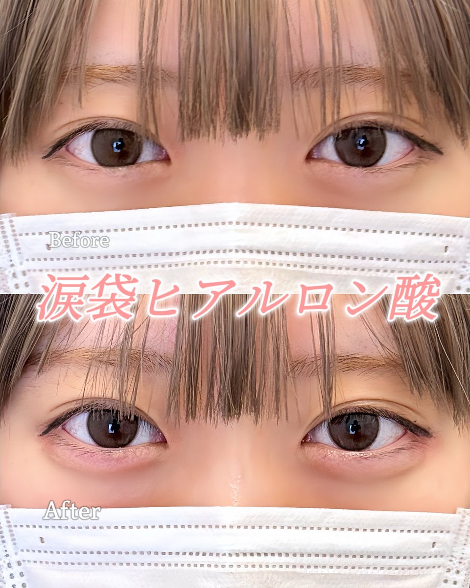 lula_hiroshima's tweet photo. 垢抜けヒアル👀💖涙袋人気です✨
ナチュラルからぷっくりまでデザイン可能です(^^)
ルラでお待ちしてます🍂

#ルラ美容クリニック https://t.co/I4Vxyn0xfM