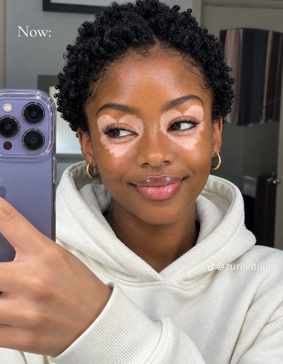 dawgdeyfool's tweet photo. her vitiligo is beautiful and it’s also shaped like “love”❤️ https://t.co/5V0qpytBXF