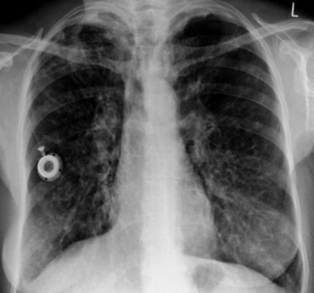 RadMasterclass's tweet photo. CHEST X-RAY 31: Patient with repeated chest infections. What is the medical device and what is the underlying diagnosis? Answer https://t.co/jBdJAdC8lV https://t.co/znikpXzEk6