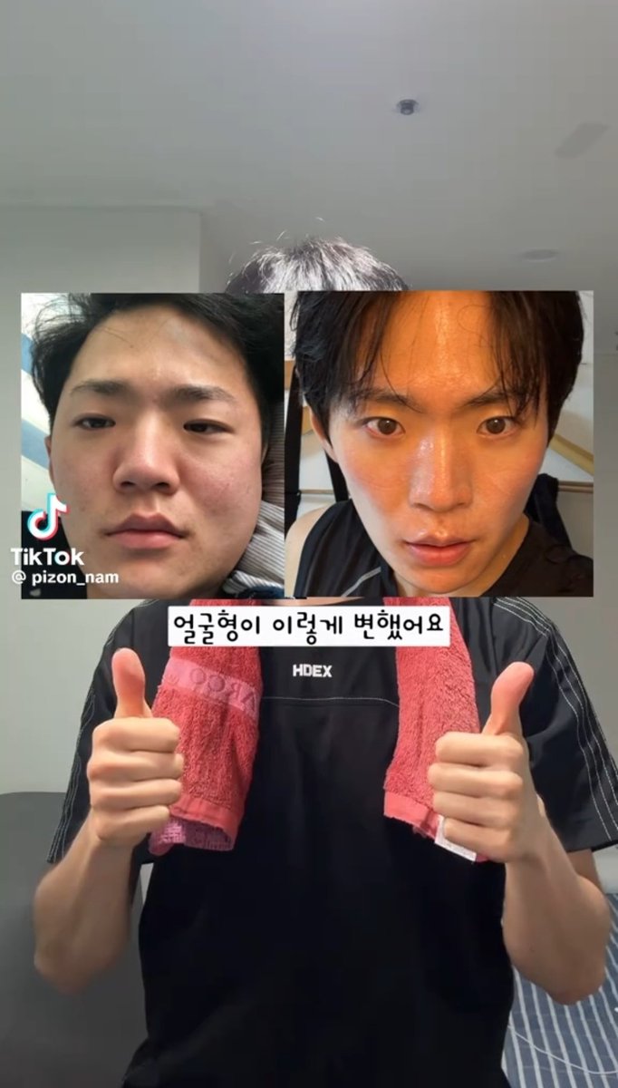 hyunxmugi's tweet photo. อย่างที่ผมบอกว่าผมไปนวดมาเมื่อวันก่อนก็เลยเอาคลิปวีดีโอนี้ที่เห็นว่าเป็นไวรัลอยู่ในเกาหลี ไปสอบถามผู้เชี่ยวชาญมาให้ด้วยครับ

เห็นว่าน่าสนใจมาก 👀✨ และทำได้ง่ายดี แต่อยากรู้ว่ามีผลไหมกับอาการปวดเมื่อยและเรื่องที่ว่าน่าจะเล็กลง ㅡ

ในคลิปเขาใช้ “ผ้าขนหนู” ช่วยยืดคอแบบนี้เป็นประจำ วันละประมาณ 10 นาที โดยทำข้างละ 5 นาที เจ้าของคลิปทำต่อเนื่องมานานและบอกว่ารูปหน้าของตัวเองเปลี่ยนไปด้วย

พอดีเมื่อวันก่อนผมไปนวด 스포츠 마사지 (Sports Massage) มา เลยเอาคลิปนี้ไปให้อาจารย์ดูแล้วถามตรง ๆ เลยว่า

“อันนี้มันช่วยเรื่องรูปหน้าได้จริงเหรอครับ?”

Sports Massage จะต่างจากนวดไทยที่หลายคนน่าจะคุ้นเคยอยู่นิดหน่อยครับ เพราะจะเน้นทำงานกับกล้ามเนื้อ จุดที่ตึงจากการใช้งาน ท่าทาง และการเคลื่อนไหวของร่างกายมากกว่า ผมเลยถือโอกาสเอาคลิปนี้ไปถามอาจารย์ด้วยเลยครับ

อาจารย์บอกว่า ถ้าจะบอกว่าทำแล้ว “เปลี่ยนโครงหน้าหรือทำให้หน้าเล็กลง 100%” แบบนั้นยืนยันไม่ได้ครับ แต่มีผล. . .

ที่ยืนยันไม่ได้ 100% ก็เพราะแต่ละคนมีโครงสร้างและสภาพร่างกายไม่เหมือนกัน

แต่ตัวท่ายืดแบบนี้มีประโยชน์จริง 👍

ถ้าทำอย่างสม่ำเสมอในระยะยาว อย่างน้อยประมาณ 3 เดือนขึ้นไปจนกลายเป็นรูทีน จะช่วยยืดและคลายบริเวณคอกับบ่า ทำให้คอที่หดเกร็งดูยืดและตั้งขึ้น ท่าทางโดยรวมดีขึ้น 

พอช่วงคอกับบ่าดูเปิดขึ้น บางคนก็เลยรู้สึกว่า “หน้าดูเล็กลง” 

หรือเส้นรอบใบหน้าดูเปลี่ยนไปได้ครับ

โดยเฉพาะคนที่นั่งหน้าคอมนาน ๆ ก้มโทรศัพท์บ่อย มีอาการคอยื่น/หลังคอเต่า หรือคอและบ่าเกร็งง่าย อาจารย์บอกว่าเป็นท่าเบสิกที่แนะนำให้ทำเป็นประจำได้ ช่วยคลายความเมื่อย ความตึง รวมถึงความเหนื่อยล้าที่สะสมบริเวณคอและบ่าได้ด้วย

ส่วนเรื่อง “ทำแล้วรูปหน้าเปลี่ยนไหม” อาจารย์บอกว่าบางคนเห็นความเปลี่ยนแปลงจริง 

แต่ไม่ใช่สิ่งที่รับประกันได้กับทุกคน และไม่ใช่ทำสองสามวันแล้วจะเห็นผลนะครับ ㅡ ต้องทำสม่ำเสมอเป็นเดือน ๆ

ผมชอบคำตอบนี้นะ เพราะไม่ได้บอกว่า “ทำแล้วหน้าเล็กแน่นอน!” แต่ดีต่อสุขภาพจริง

เอาเป็นว่าต่อให้เรื่องรูปหน้าจะเปลี่ยนหรือไม่เปลี่ยน อย่างน้อยก็ได้ยืดคอคลายบ่าจากการนั่งจ้องคอมทั้งวันครับ

วิธีทำตามในคลิปเลย
① คล้องผ้าขนหนูบริเวณคอ
② ไขว้มือจับปลายผ้าทั้งสองข้าง
③ ยกมือด้านบนขึ้นไปเหนือหู
④ ค่อย ๆ ดึงผ้าไปคนละทิศเพื่อยืดคอ
⑤ ตอนหายใจออก ค่อยเพิ่มแรงดึงเบา ๆ
⑥ ทำอีกด้านเหมือนกัน

ในคลิปแนะนำข้างละประมาณ 5 นาที รวมวันละ 10 นาทีครับ

แต่ค่อย ๆ ยืดนะครับ ไม่ใช่เห็นคำว่า “หน้าเล็ก” แล้วดึงคอตัวเองสุดแรง 🫵😭 ไม่ได้! ถ้าเจ็บ ชา เวียนหัว หรือรู้สึกผิดปกติก็หยุดก่อนนะครับ

ใครทำงานหน้าคอม เล่นมือถือ หรือวาดรูปจนคอจะกลายเป็น 🐢 (แบบเด็ก ๆ เต่าทั้ง 4 ที่บ้านผม) ลองเอาไปทำเป็นรูทีนกันได้ครับ 

วีดีโอและเครดิตอยู่ในโพสต์นี้เลย :}
