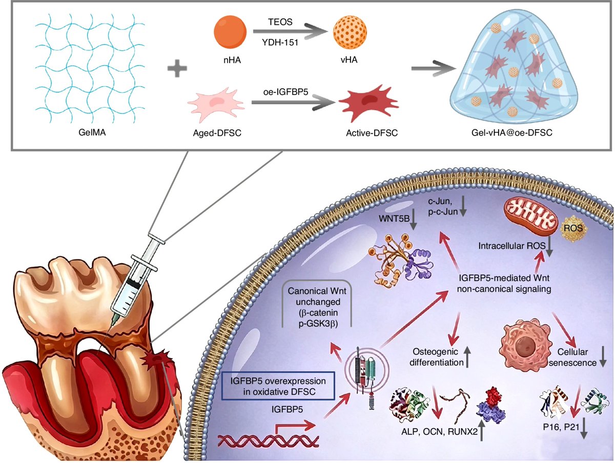 SciTechera's tweet photo. REGENERATIVE BREAKTHROUGH:

welcome to the everyday breakthrough era.

Scientists just found a new way to partially rejuvenate aging human dental follicle stem cells and restore their ability to form bone.👀

The key appears to be IGFBP5.

As these stem cells become senescent, IGFBP5 levels decline, weakening their regenerative capacity.

Researchers just restored IGFBP5, which reduced cellular senescence and improved osteogenic differentiation.

They then engineered a Gel-vHA@oe-DFSC hydrogel combining:

> GelMA-based hydrogel
> Vinyl-functionalized nanohydroxyapatite
> IGFBP5-overexpressing dental follicle stem cells

In rats with periodontitis, the treatment improved alveolar bone regeneration, bone density and tissue organization.

But the bigger idea is even more interesting:

By restoring the molecular machinery that makes cells regenerative, future therapies could potentially help damaged tissues repair themselves more effectively.

This study is still preclinical. The regeneration experiment was performed in rats, not humans.

But targeting stem-cell aging itself could become an important direction for the future of regenerative medicine.

source:
https://t.co/ylyLbDXJt0

paper:
https://t.co/bx2cQWKUpJ