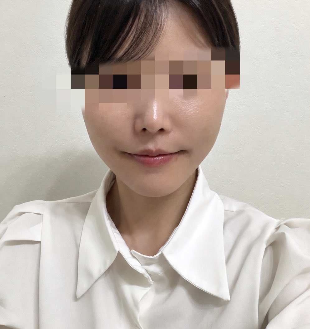 hana___24_'s tweet photo. 【糸リフトDT4日目】
朝はまだちょっと浮腫むけど夕方になるとかなりシュッとなってる！！！会社の人にも中顔面がめっちゃ短縮されたと言われ大感動！！！
個人的には顔のハリが出てきて若返りを感じられるのもかなり嬉しい😭✨✨ https://t.co/kDeE4WNsru