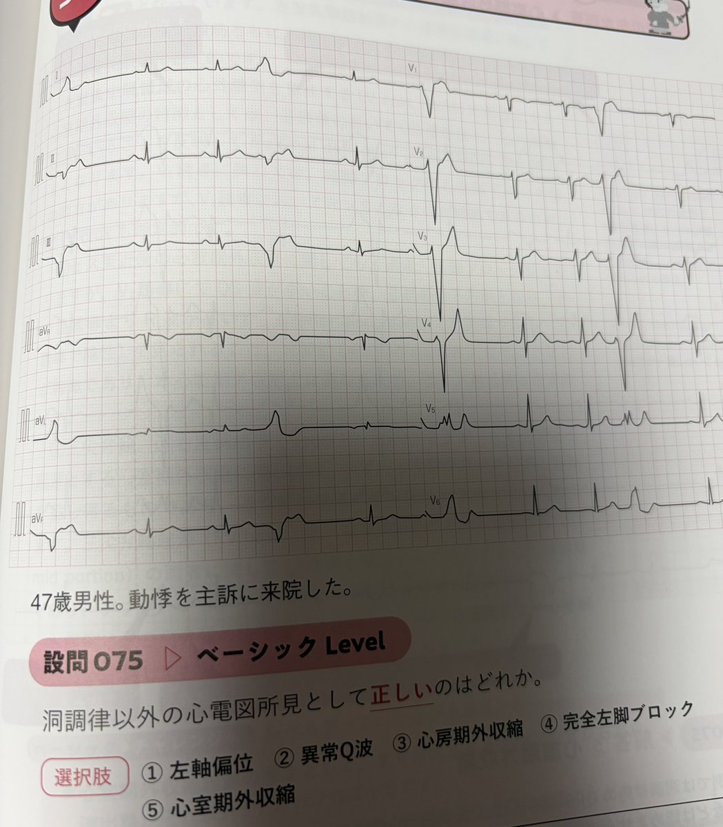Ns_ss0906's tweet photo. 心電図トレーニング100…もうわけわからん…
え？どゆこと？？
わたしの理解力が低すぎるのか？

「洞調律以外の」って期外収縮の所見ってことだよね？？
解説は「洞調律中のQRSは正軸で〜」って書いてて、頭が？？？？
洞調律以外の所見じゃないの？？？？
むしろPAC以外全部当てはまると思ったよ… https://t.co/SUHlmaaHlf