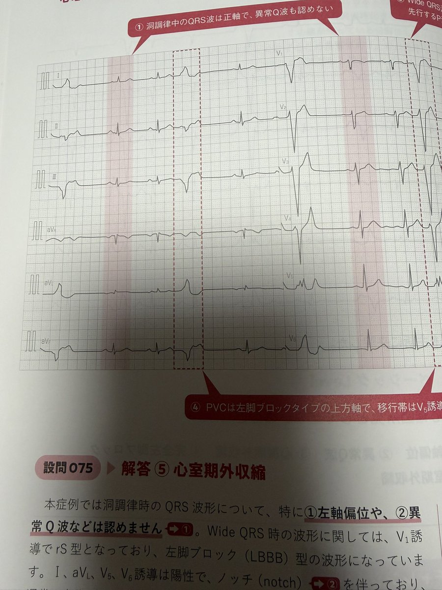 Ns_ss0906's tweet photo. 心電図トレーニング100…もうわけわからん…
え？どゆこと？？
わたしの理解力が低すぎるのか？

「洞調律以外の」って期外収縮の所見ってことだよね？？
解説は「洞調律中のQRSは正軸で〜」って書いてて、頭が？？？？
洞調律以外の所見じゃないの？？？？
むしろPAC以外全部当てはまると思ったよ… https://t.co/SUHlmaaHlf